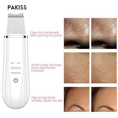LateurGo Vibrance Ultrasonic Skin Scrubber FY-400B